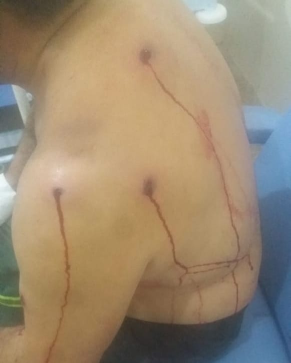 Vendedor de gás é baleado várias vezes em tentativa de latrocínio em São Pedro do PI