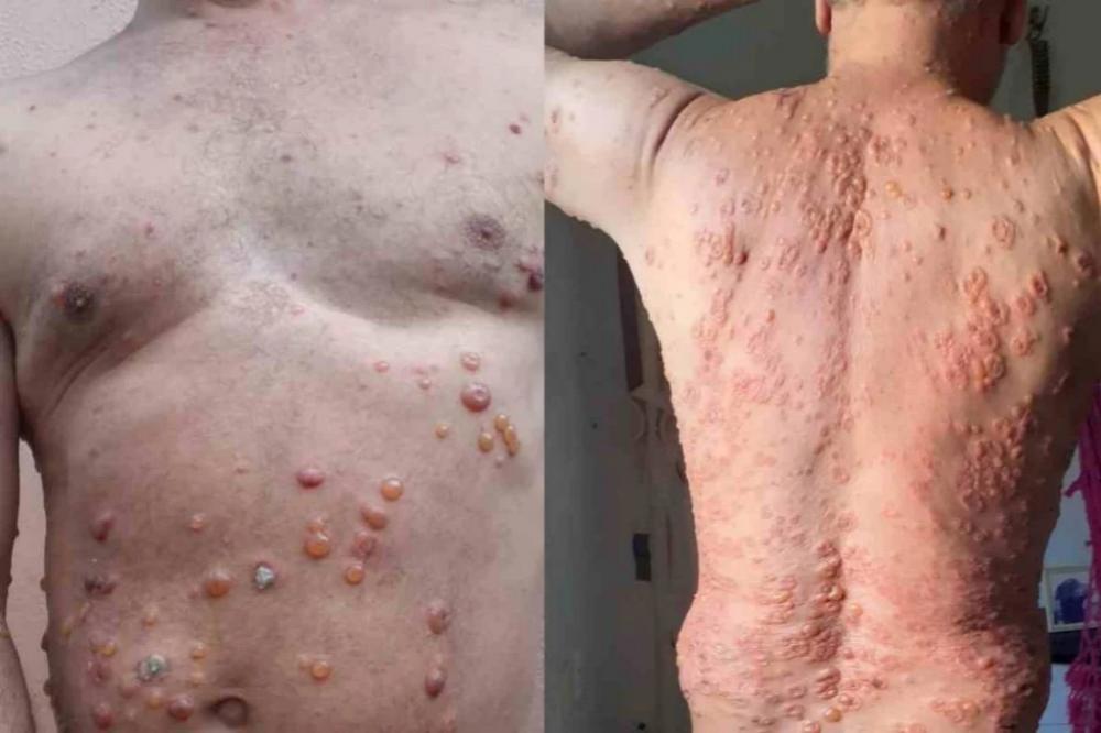 Piauiense de 53 anos desenvolve bolhas por todo o corpo após usar 'kit Covid'