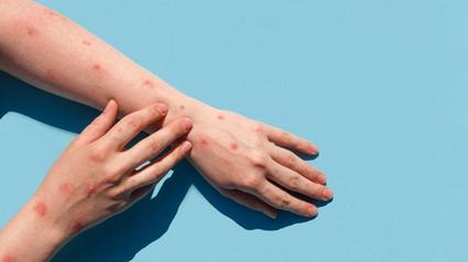 Monkeypox: caso suspeito é descartado em Picos